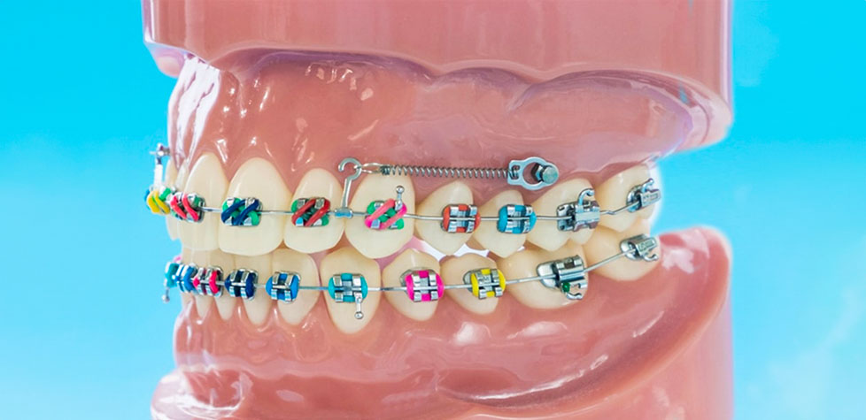 A Qualidade dos parafusos ortodônticos para a ancoragem em odontologia