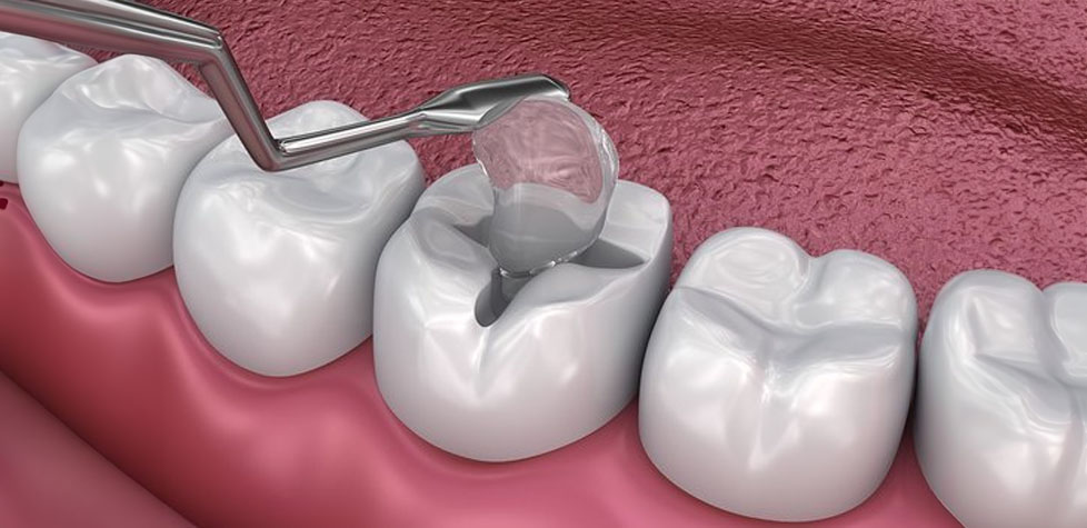 Padrões de materiais restauradores odontológicos