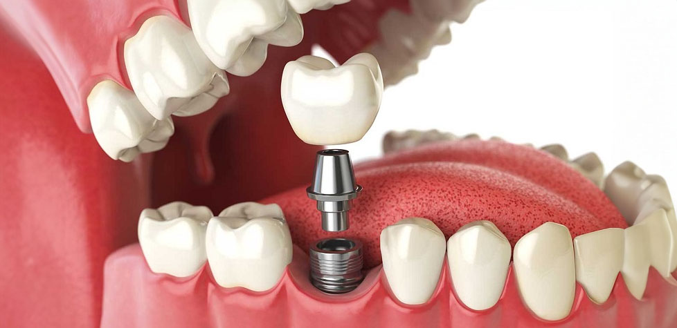 Os dentes artificiais para próteses dentárias